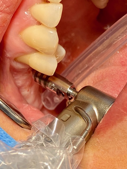 Préparation du site à implanter avec un tissue punch shaver