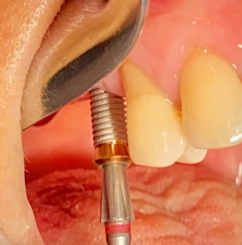 Insertion de l’implant dans la zone édentée